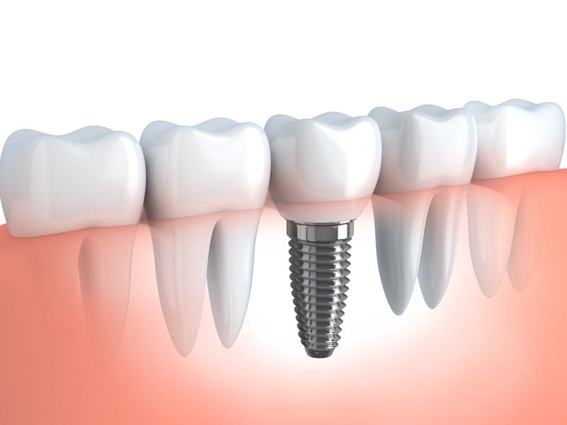 Dental Implants Las Vegas, NV