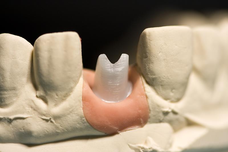 Implant Restoration Las Vegas, NV