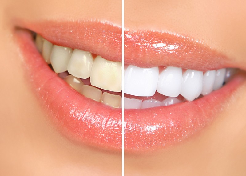 Teeth Whitening  Las Vegas, NV 