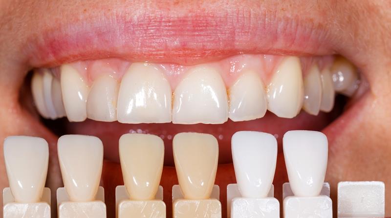 Veneers Las Vegas, NV